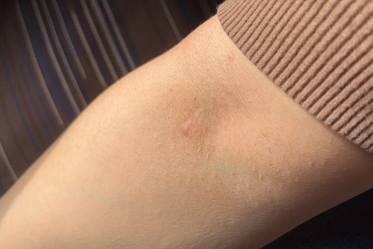 免拆线缝合伤口愈合图