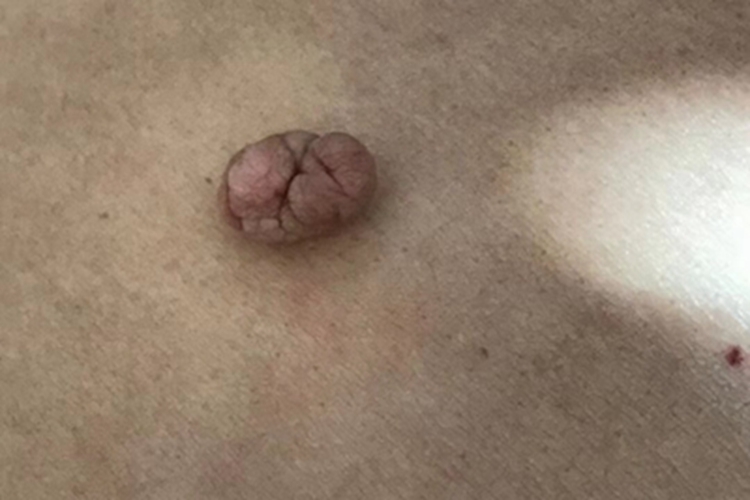 皮肤纤维瘤软包图