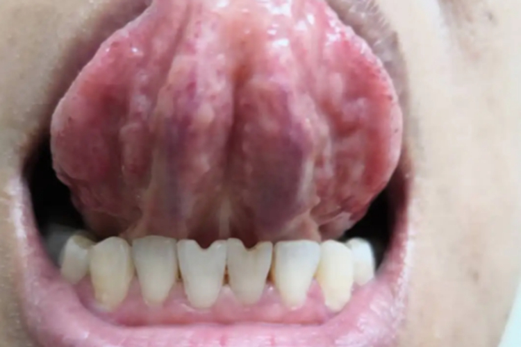 舌下脉管畸形图