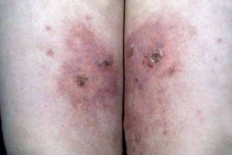 Ⅲ度冻伤腿发紫图