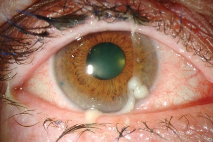 腺病毒性角结膜炎眼部化脓图