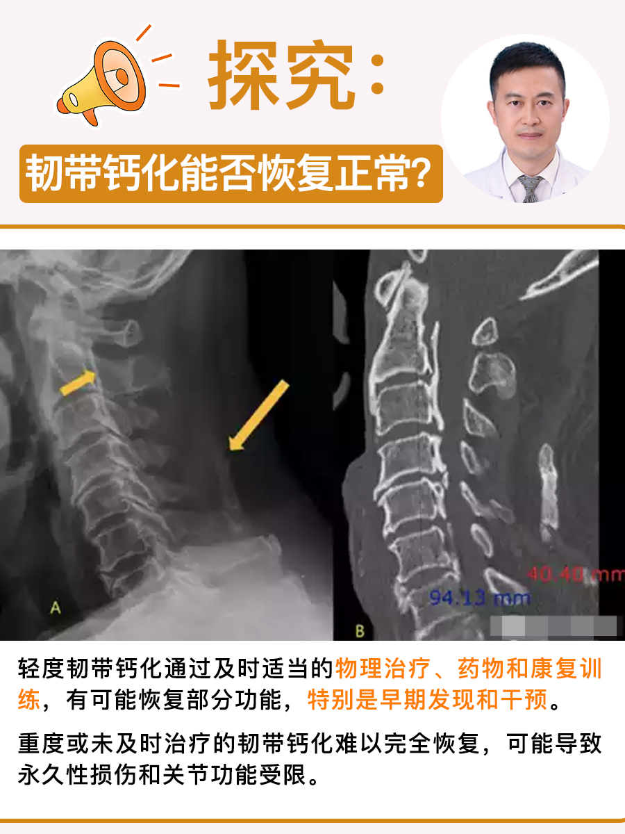 探究：韧带钙化能否恢复正常？