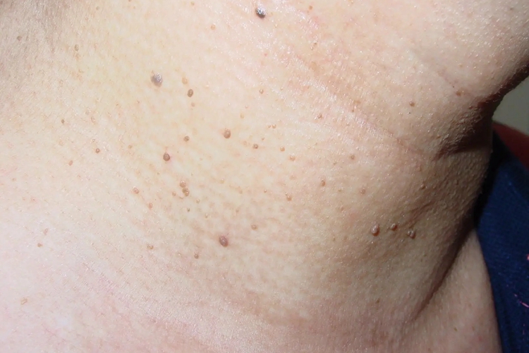 小丘疹型软纤维瘤早期图