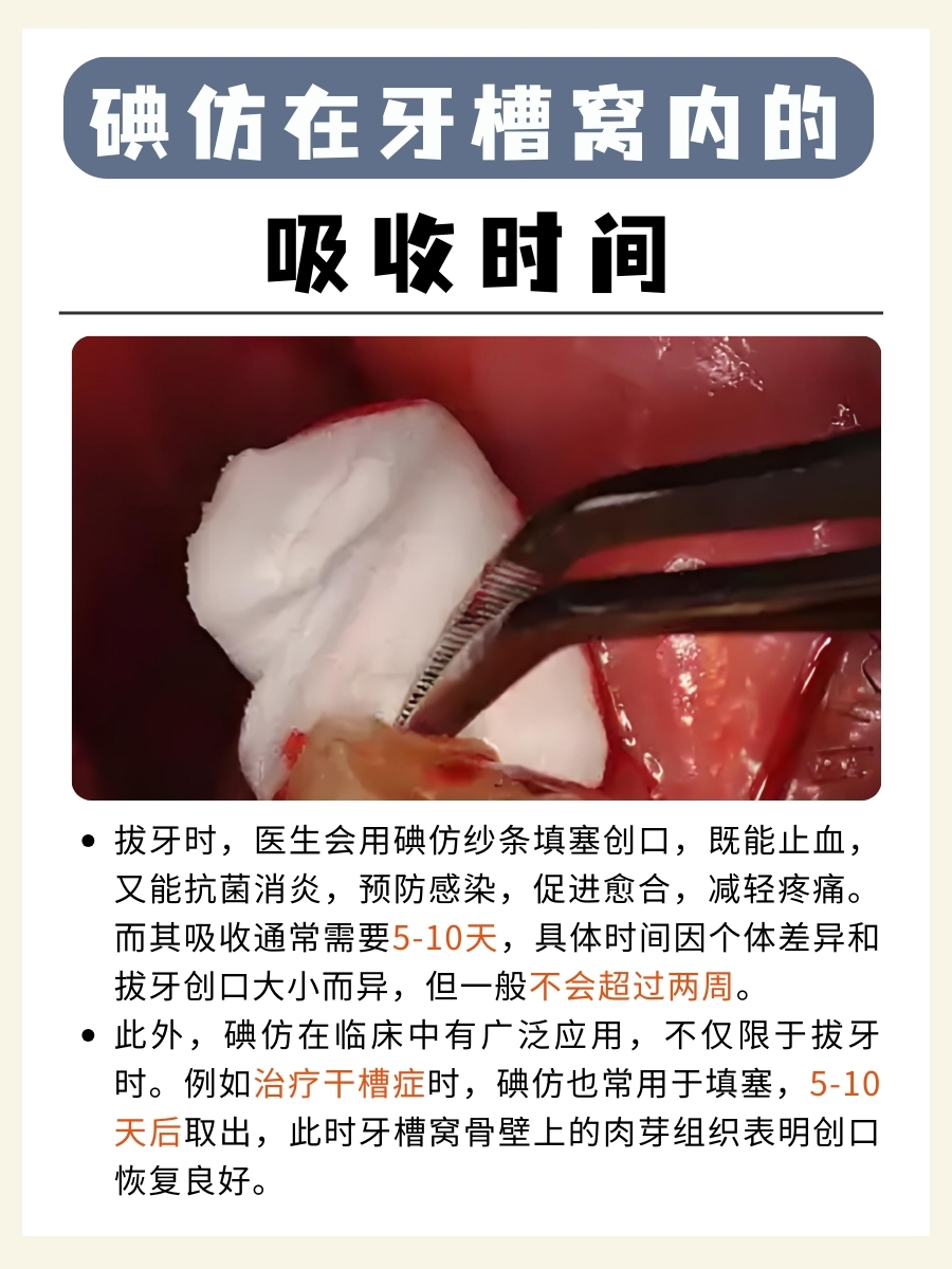 碘仿放进牙槽窝,几天能吸收完?答案来了!