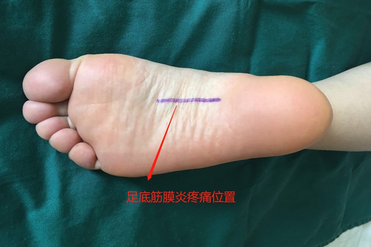 右脚足底筋膜炎内侧疼痛部位图