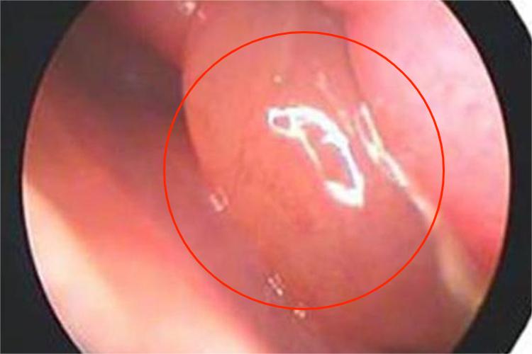 急性鼻窦炎鼻窦肿大图