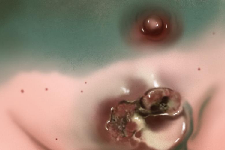 乳腺癌晚期溃疡图