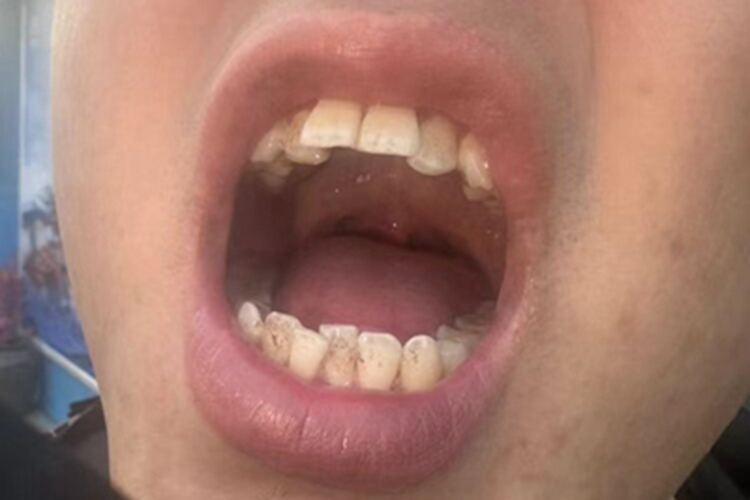 龅牙上门牙外凸图 龅牙上门牙外凸图