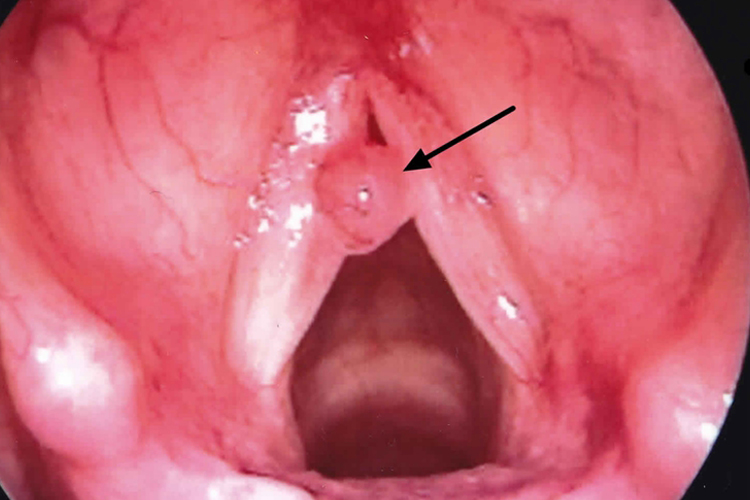 镜下声带小结图