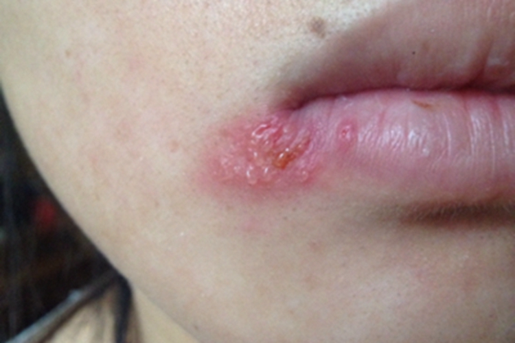 口腔单纯性疱疹口周症状图 口腔单纯性疱疹口周症状图