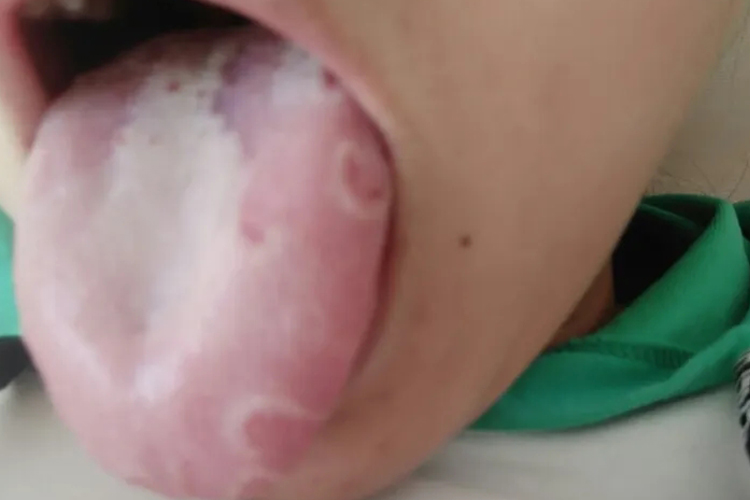 扁平苔藓图 扁平苔藓图