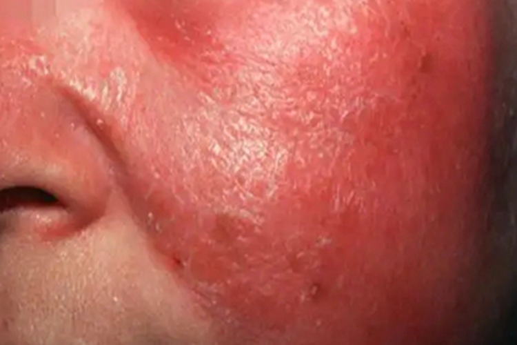 急性网状淋巴管炎面部水肿图 急性网状淋巴管炎面部水肿图