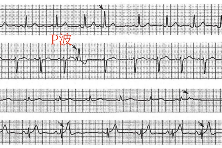 房性期前收缩心电图 房性期前收缩心电图