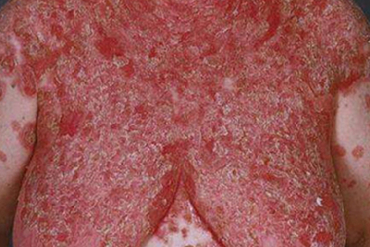 天疱疮胸部红斑图