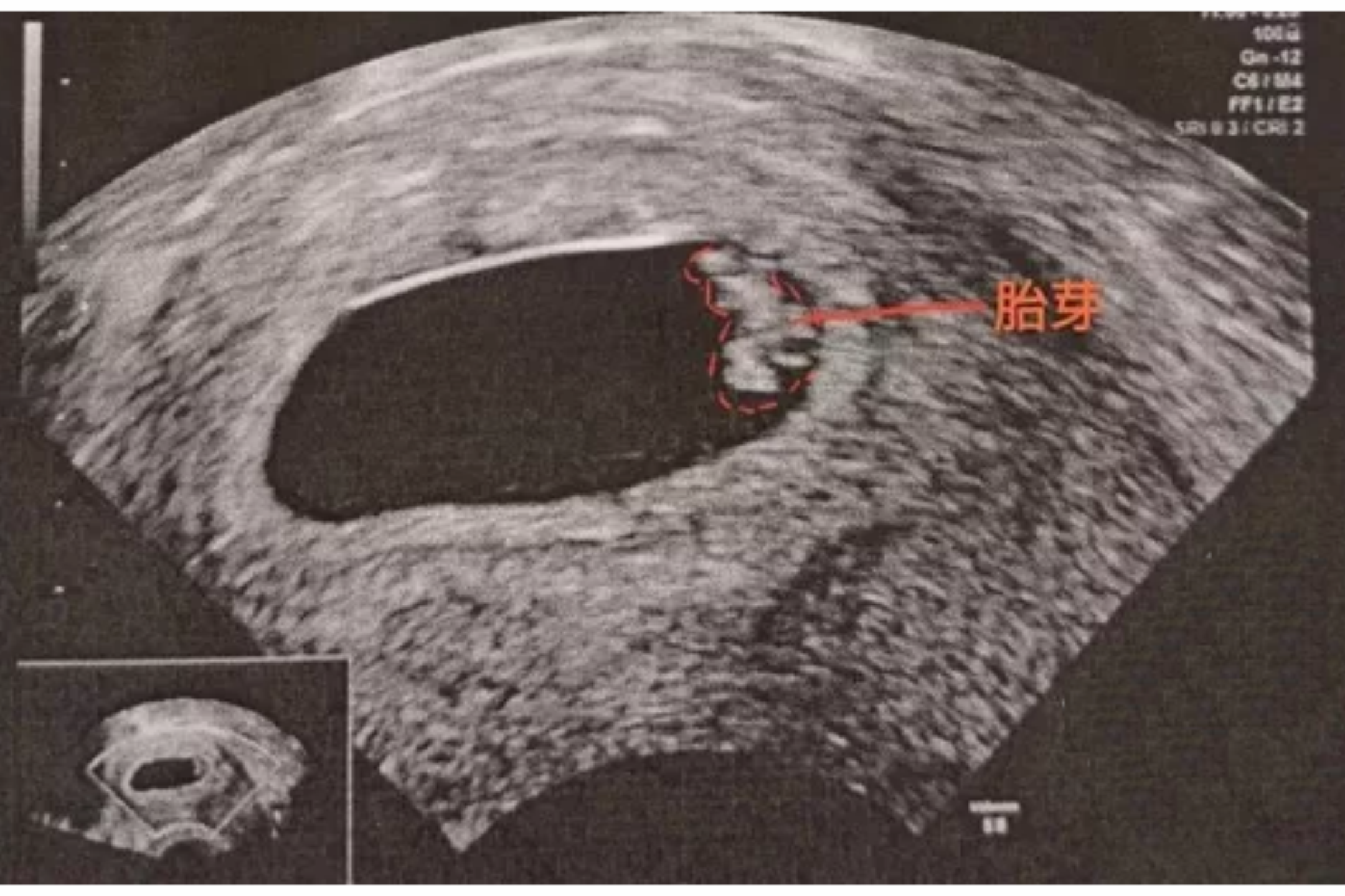 23周胎心位置示意图图片