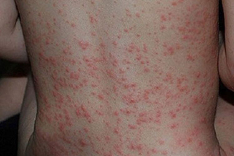 胆碱能性荨麻疹症状图