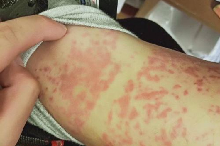 红斑狼疮腿上红斑图 红斑狼疮腿上红斑图