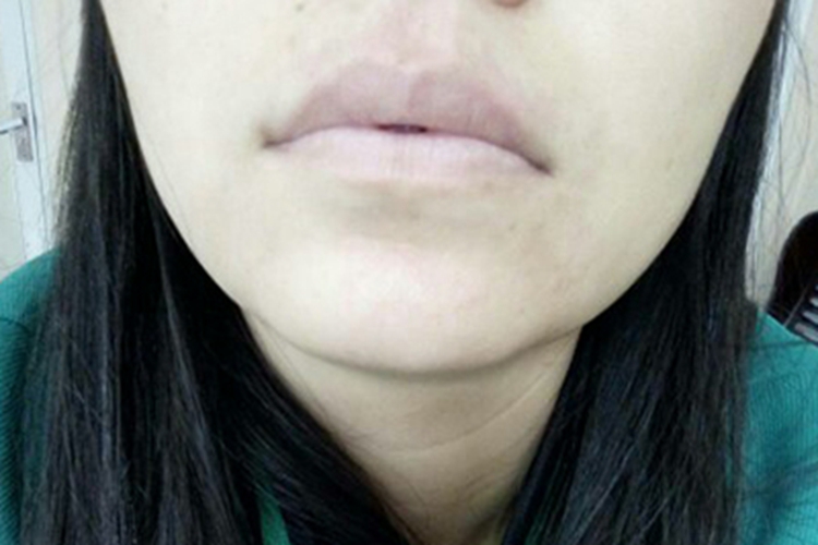 缺铁性贫血嘴唇苍白图