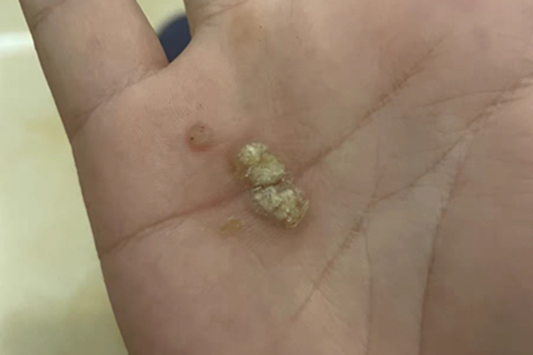 寻常疣手掌皮肤粗糙图 寻常疣手掌皮肤粗糙图