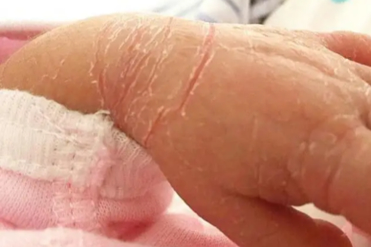 婴儿寻常型鱼鳞病图 婴儿寻常型鱼鳞病图