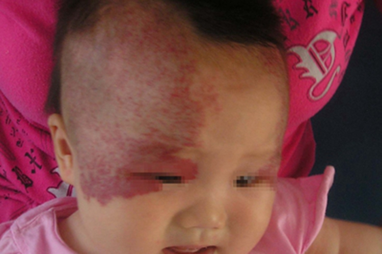 丛状血管瘤头皮上大片紫斑疙瘩图