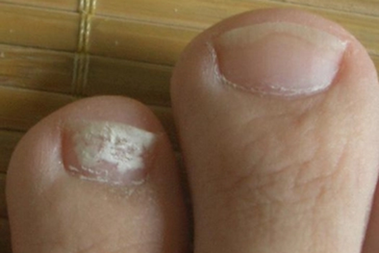 甲癣脚趾甲变白图