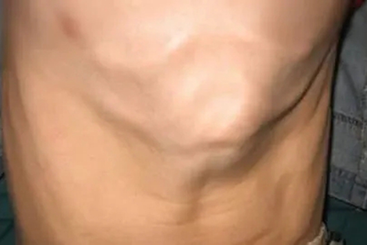 鸡胸胸骨剑突凸起图