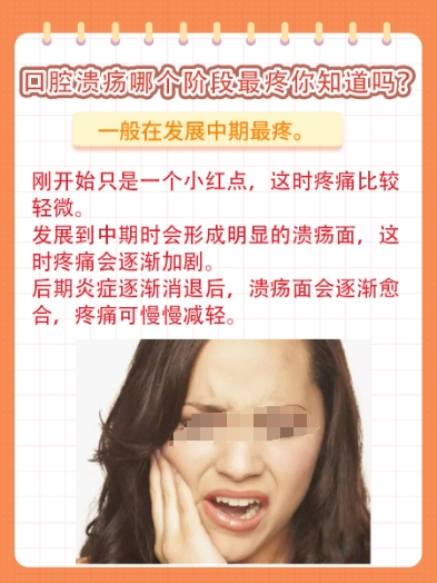 口腔溃疡哪个阶段最疼你知道吗?医生告诉你