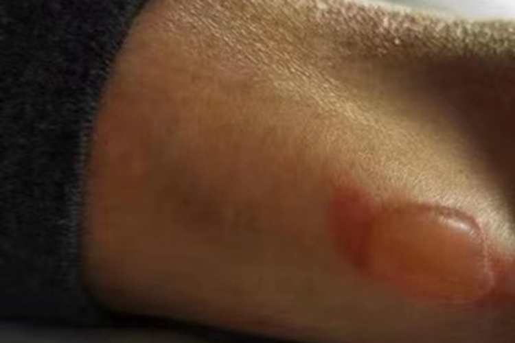 蜈蚣蜇伤症状图 蜈蚣蜇伤症状图