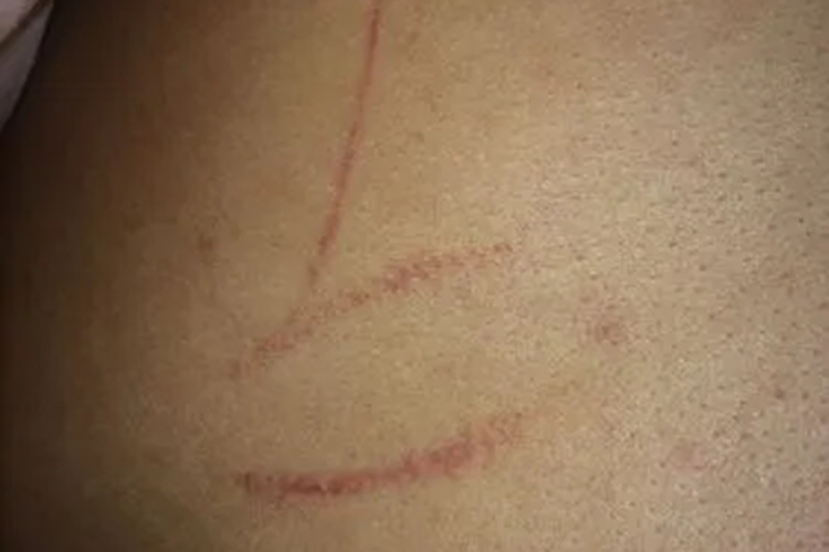 线状指甲抓痕图