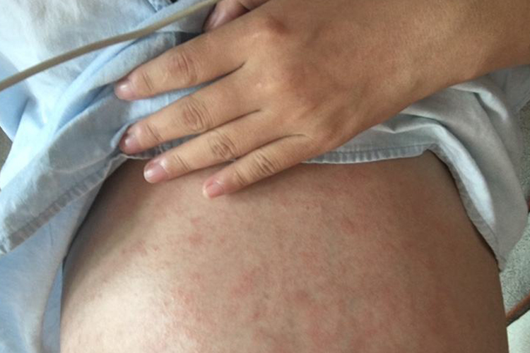 胆汁酸高起疹的图片