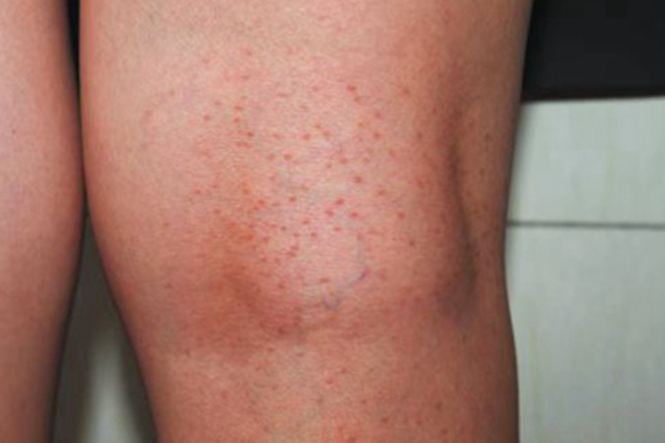 光泽苔藓丘疹图 光泽苔藓丘疹图