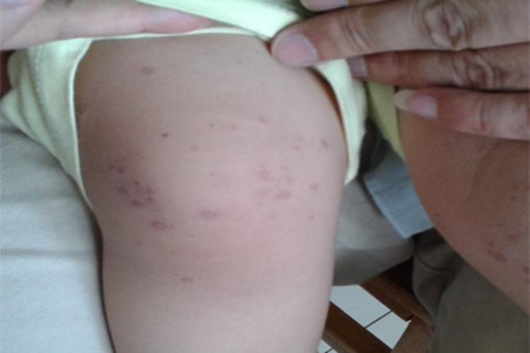 汗孔角化症膝盖症状图