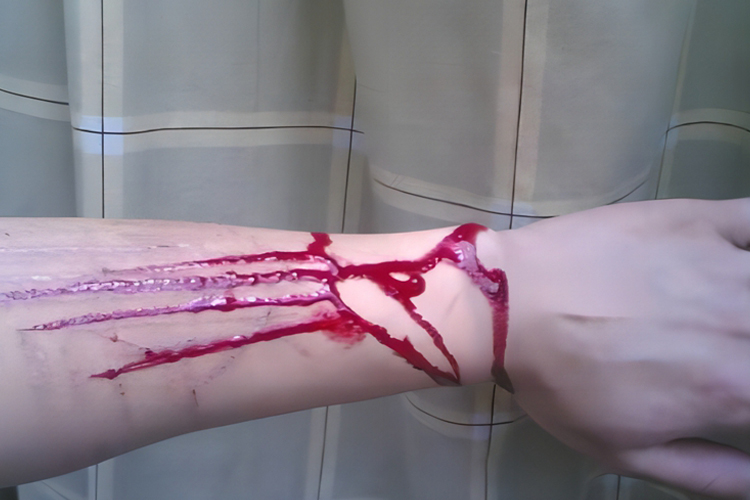 胳膊出血真实图