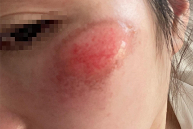 擦伤面部发红图