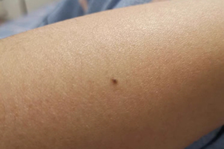 皮内痣胳膊黑痣图
