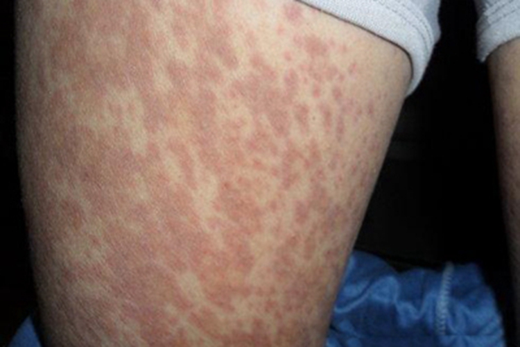 类脂质渐进性坏死大腿红斑图