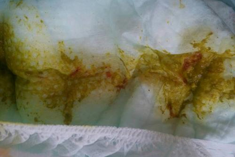 维生素K缺乏症患儿大便带血图