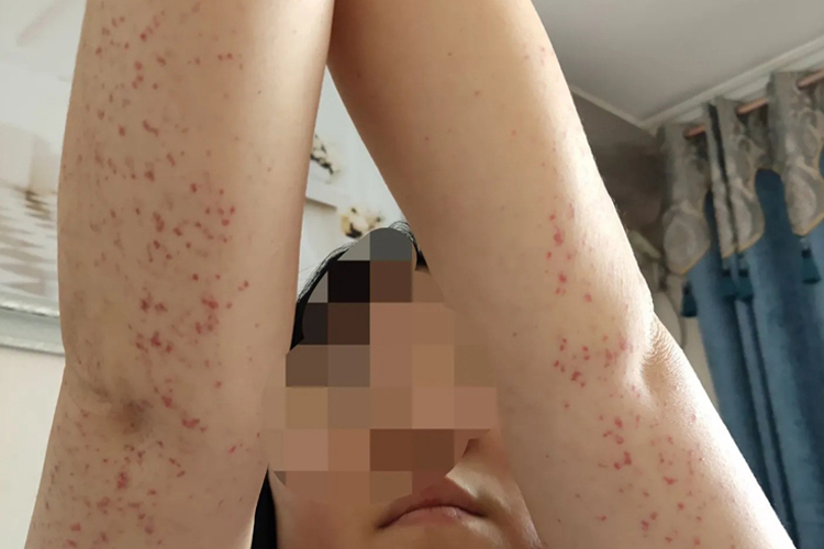 手臂紫癜伴出血点图 手臂紫癜伴出血点图