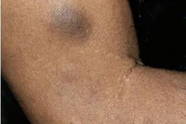 皮肤白血病胳膊有黑斑图