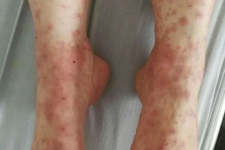 轻型多形红斑型药疹脚部红斑图