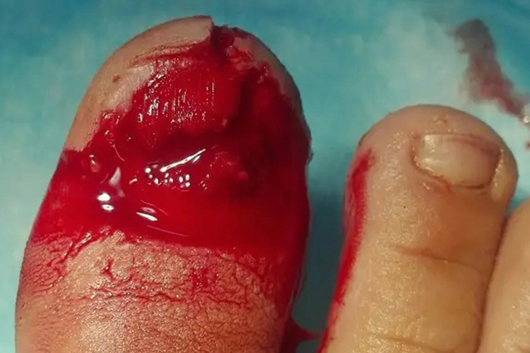 大脚趾骨折表面出血图