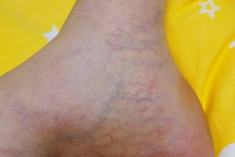 特发性网状青斑脚踝症状图