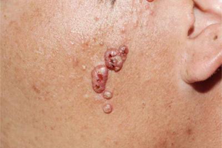 乳头状汗管囊腺瘤面部疙瘩图 乳头状汗管囊腺瘤面部疙瘩图