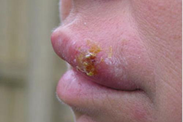 艾滋病嘴唇红肿图