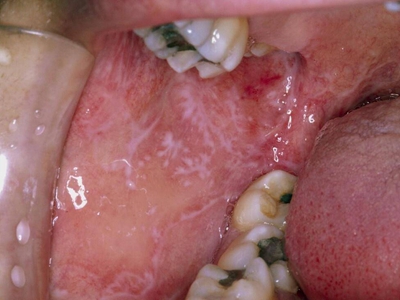 口腔白色线状苔藓图片图片
