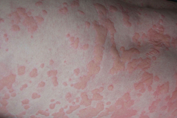 吃巴沙鱼过敏身上荨麻疹图 吃巴沙鱼过敏身上荨麻疹图