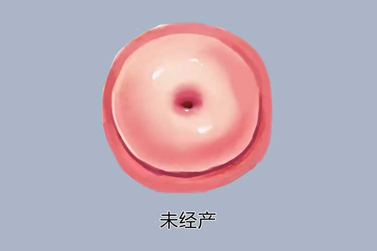 未产妇子宫颈外口图