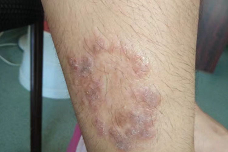 体癣小腿水疱图