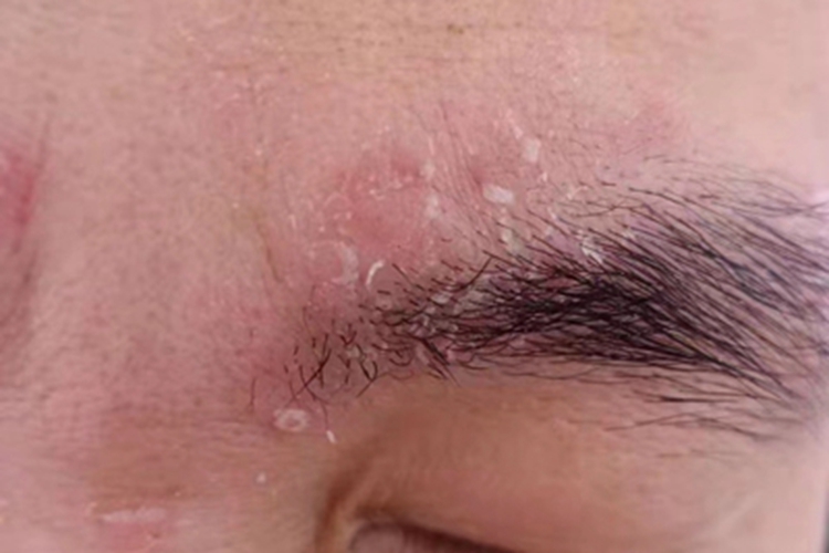 寻常型银屑病眉毛红斑图